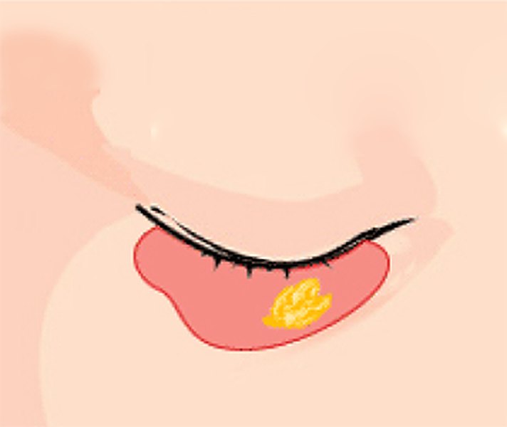 눈밑지방재배치 ② 지방 재배치