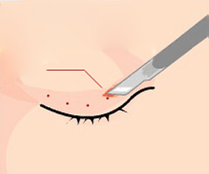 부분절개법 — 5mm 미만 최소절개 그림