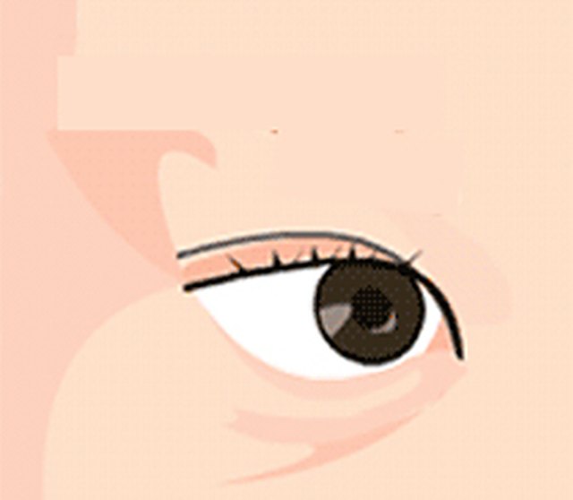 하안검 ① 처진 눈밑