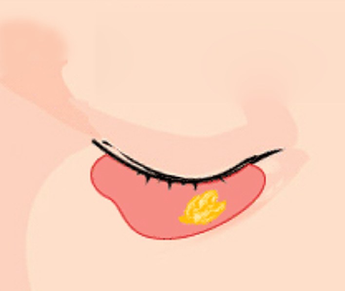 눈밑지방재배치 ② 지방 재배치