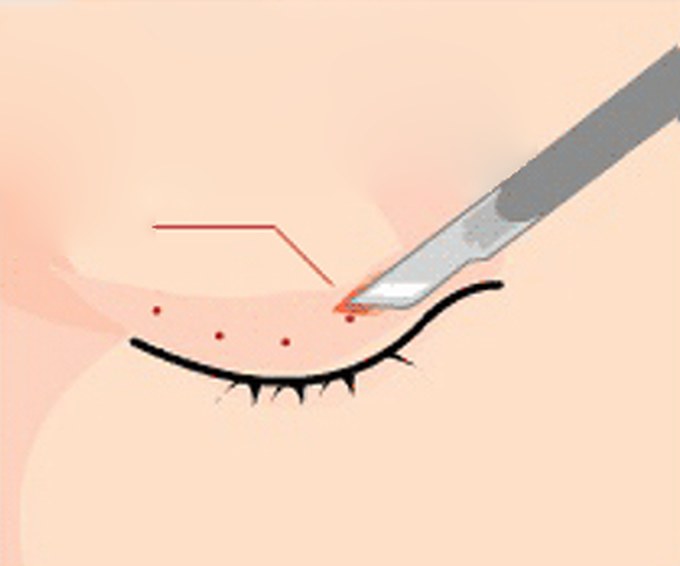 부분절개법 — 5mm 미만 최소절개 그림