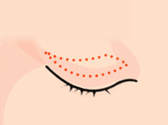 상안검 ① 처진 윗눈꺼풀 절개선 표시