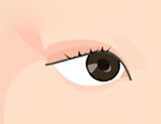 상안검 ③ 수술 후 그림